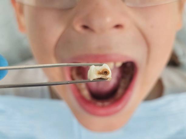 Best Broken or Chipped Tooth Repair in Pennsboro, WV